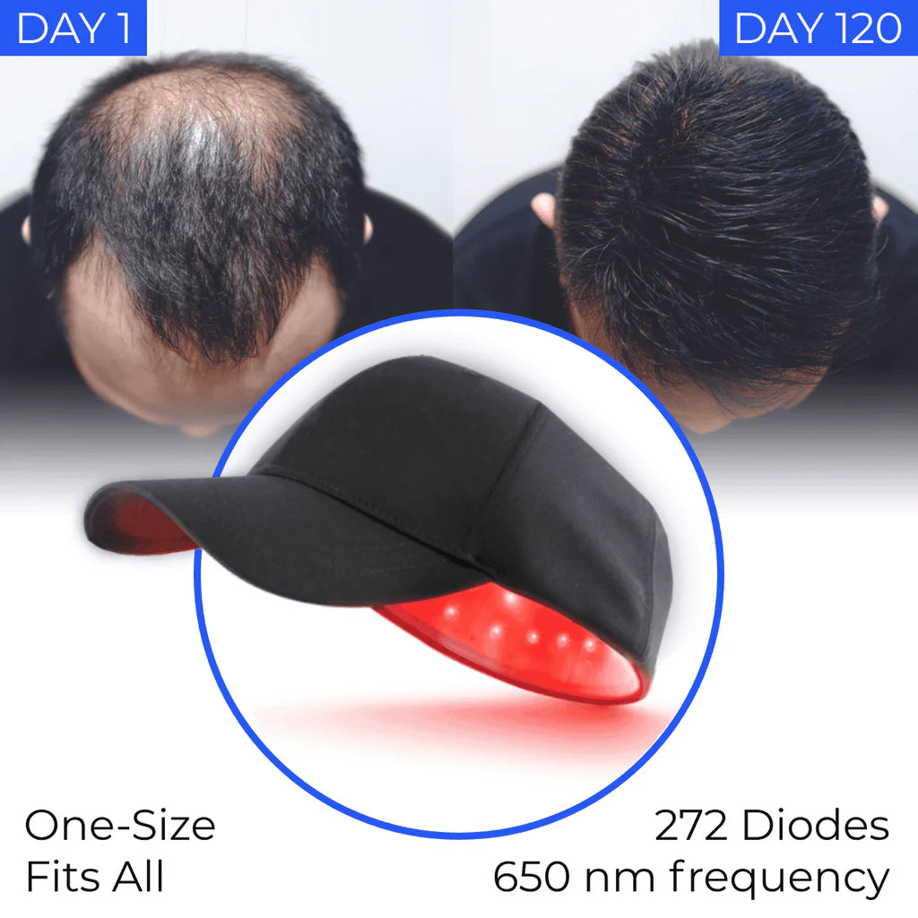 ByronBiolabs® Laser Cap – A Breakthrough in Hair Regrowth